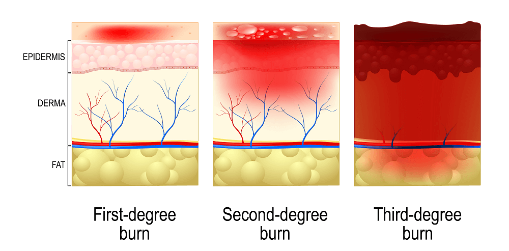 Practical First Aid For Burns 